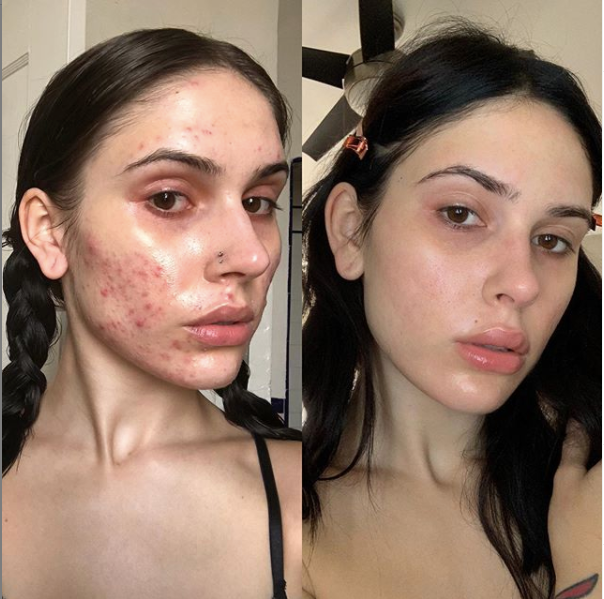 Hormonal Acne Supplement