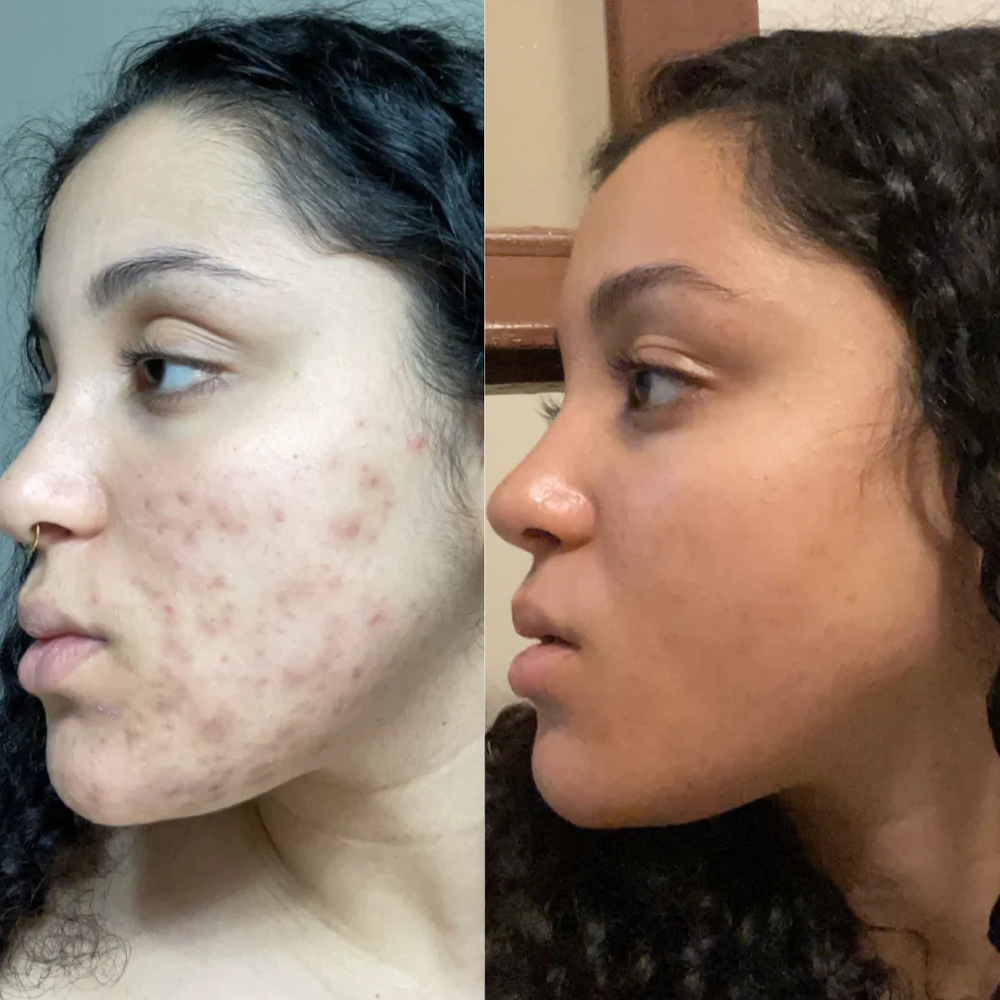 Hormonal Acne Supplement