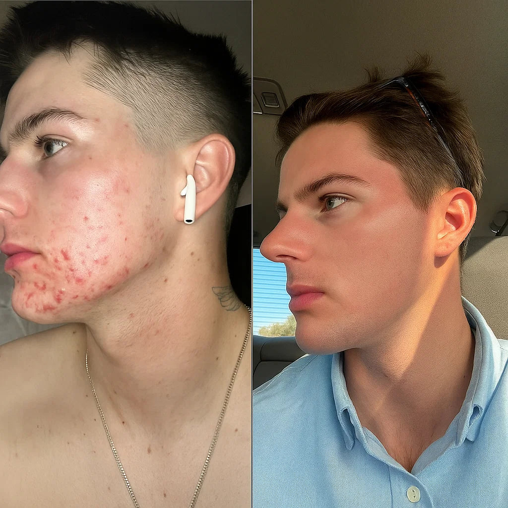 Hormonal Acne Supplement