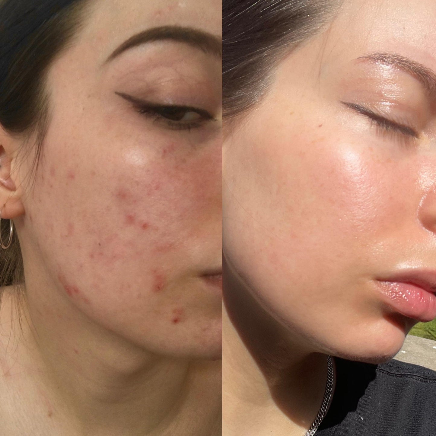 Hormonal Acne Supplement